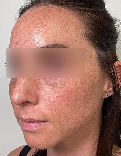 Sculptra — Skin Firmness - After